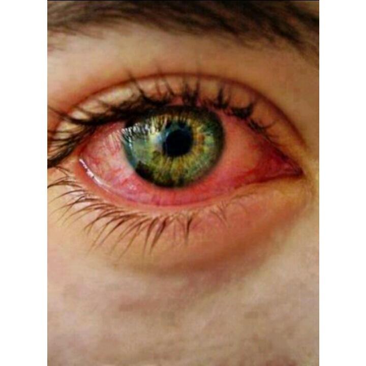 Como Deshinchar Los Ojos De Llorar