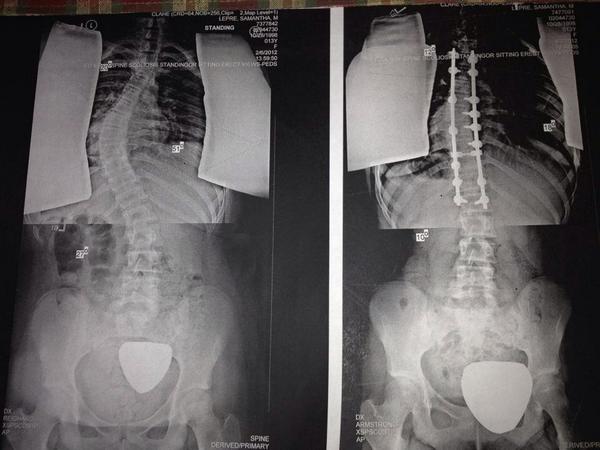 PipsSloth's tweet image. “@ddlovato: Physical disabilities are NOTHING to joke about. SEVERE SCOLIOSIS IS NOTHING TO MAKE FUN OF.” You tell em