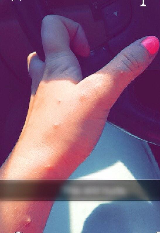 bernellsample's tweet image. Fuck fire ants 🐜