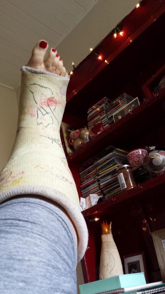astrantiaroma's tweet photo. Last day! Tomorrow the manky cast comes off! #FierceExcited #BipedAgain #SkippingHomeFromTheHosp http://t.co/OmuUFxMC9F