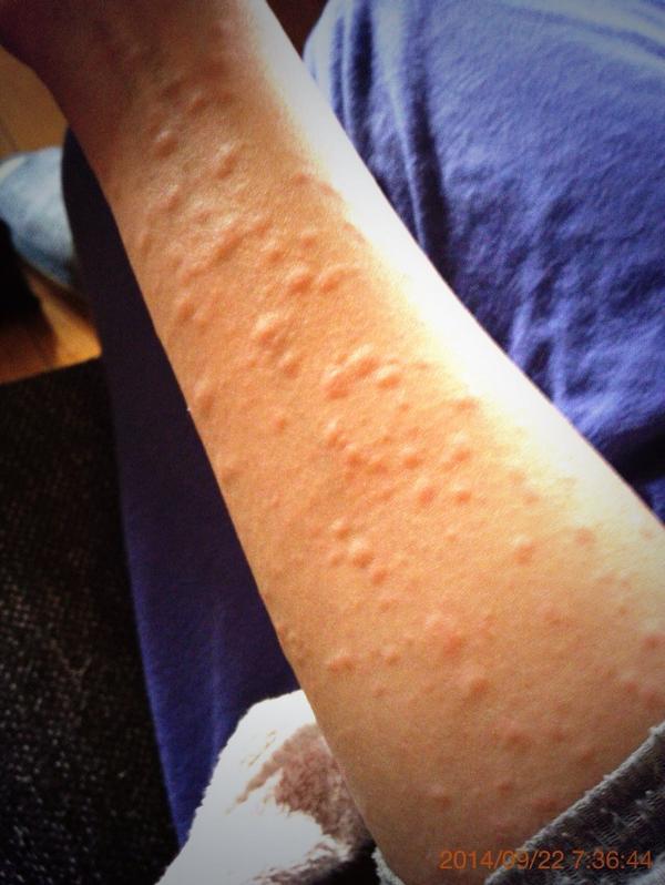 Mon 調べたらペニシリンによるアレルギーって100人に1人ぐらい現れるのね 恐い 因みに私の薬疹はこんな感じの蕁麻疹が全身に出来ましたよよよ 参考までに Http T Co Mqou4sl2on Twitter
