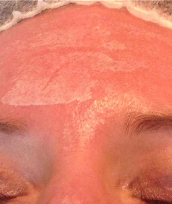 Nancy heeft haar eerste <a href="/Pascaud/">Pascaud</a> TCA #peeling ondergaan
Het resultaat na 10 dagen!