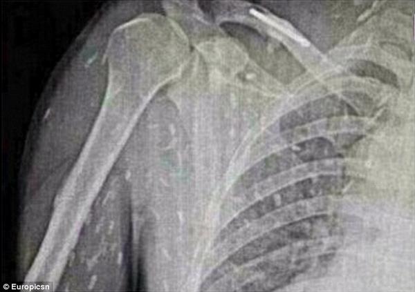 さいたま改２ Falkeschwalbel そもそも芽殖孤虫 は感染ルート自体が全くの謎なんで 1987年以降感染例が報告されて無いのは偶然なんかなんなのか なんともいえないんですよねえ D