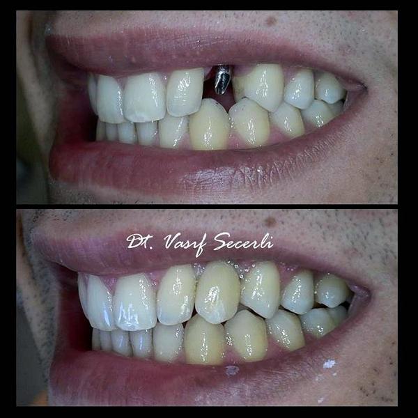Estetik bölgede implant...