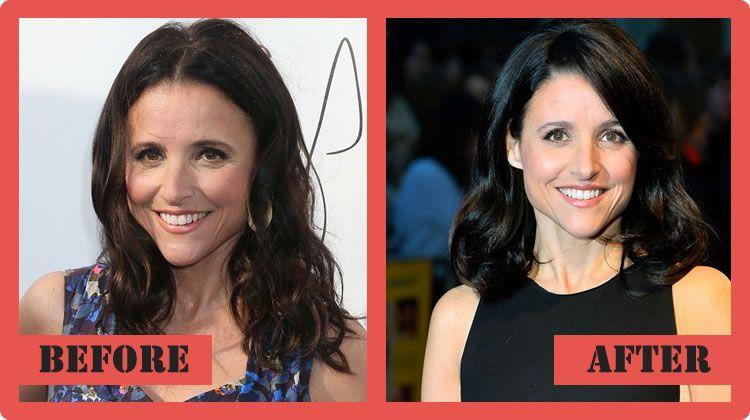 Featured - Julia Louis Dreyfus Plastic Surgery