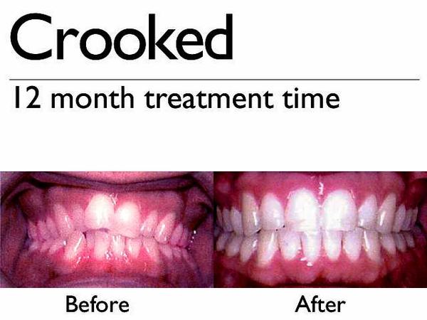 orthosnapny's tweet photo. Fast and effective #TeethStraightening #WithoutBraces. #OrthoSnapNewYork.
http://t.co/2dRX2Mu1af / 1-844-ORTHOSNAP http://t.co/ab0KESj04U