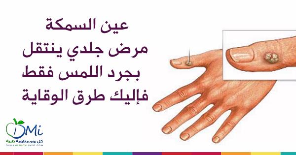 كل يوم معلومة طبية Dailymedicalinfo Com On Twitter عين السمكة