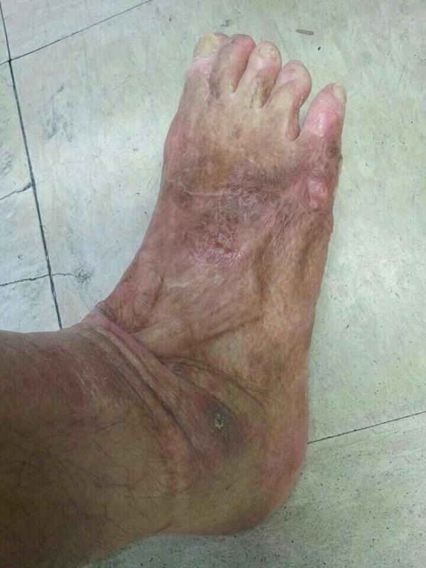 psm4950's tweet image. http://t.co/sShdoZAMny어느
소방관의 발 화재진압 과정에 입은상처 국민의
생명과 재산을 지키려다 이렇게 되었습니다,아름다운 천사의 발이 너무 가슴아프다
소방관 국가직 전환 처우개선 보장 해주어야
합니다