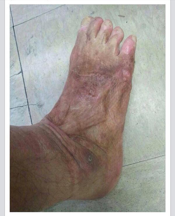 mindgood's tweet image. 화재현장에서 플라스틱 잔해가 불길에 쇳물처럼 녹아내리면서 만신창이가 된 어느 소방관의 발....이들에게  국가직을 허하라.