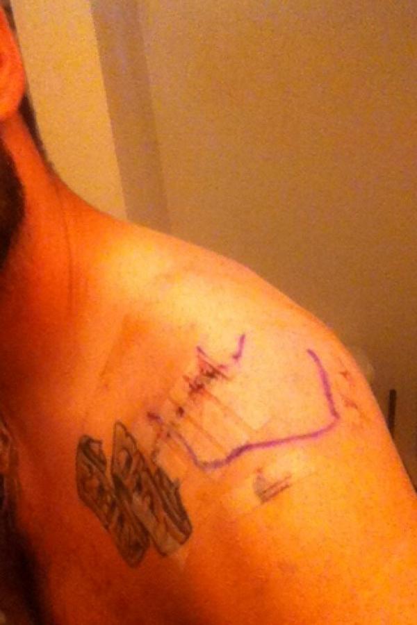 TravisHaye's tweet photo. Shoulder surgery #nflcombine #football http://t.co/3g5knwvCTR