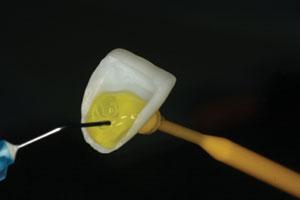 20 Tips for Resin Veneer Cements
Carlos A. Munoz-Viveros, DDS, MSD

aacd.com/index.php?modu…