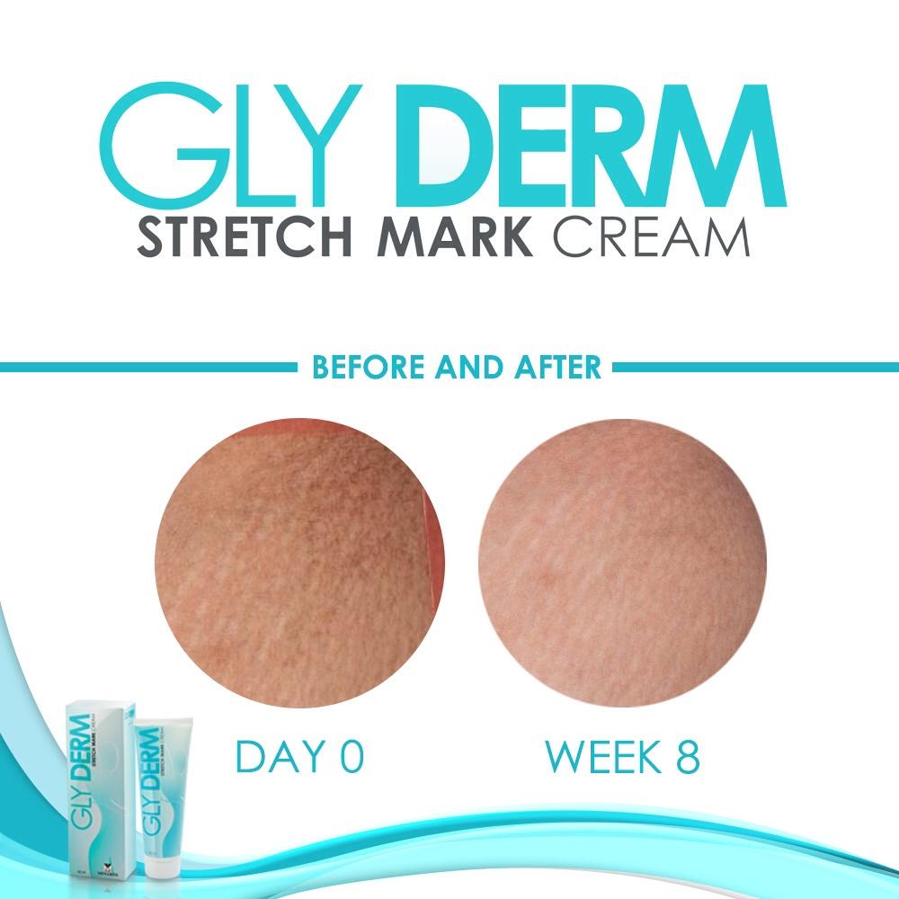 gly derm stretch mark