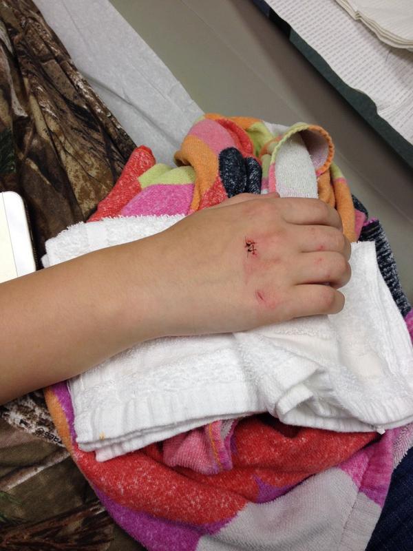 Peter_Pan12230's tweet image. Messed my hand up yesterday! #twostitches #stupid #hurtslikeabitch