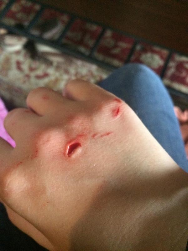 Peter_Pan12230's tweet image. Messed my hand up yesterday! #twostitches #stupid #hurtslikeabitch