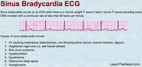 Learntheheart Com Sinus Bradycardia Ecg Heart Rate 60 Beats Minute Name At Least 7 Causes Usmle Cardiology Http T Co Ttlyjamfj6