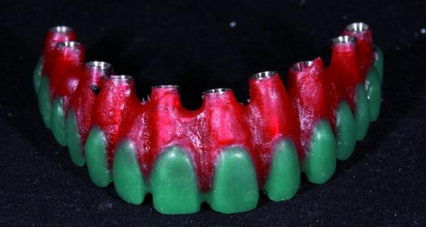 DentalTribuneIn's tweet photo. Contribution of CAD/CAM technology to implant-supported screw-retained restorations, http://t.co/hJbTwmUYzj http://t.co/hIzkxu1OcT