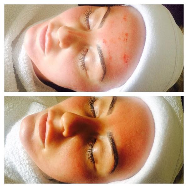radiofrequency3's tweet photo. Derma roller before and after 👌 http://t.co/XSIMSn2aA0