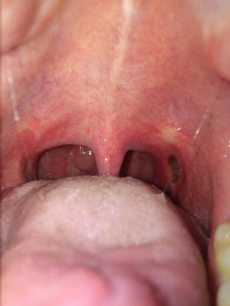 Hole In Back Of Throat 40