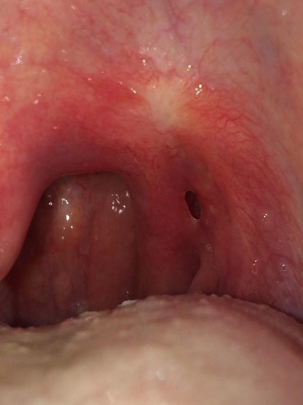 Hole In Back Of Throat 69