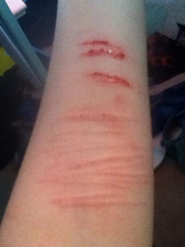 RemindScar's tweet image. The razor slipped