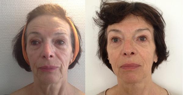 BRERAMEDICAL's tweet photo. #beforeafter #nofilter #beauty #brera #imperiummaster #noninvasive #radiofrequency #sonophoresis #peeling #ultrasound http://t.co/aNrPHS53fT