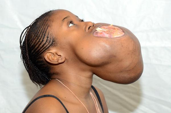 dailystar's tweet image. Teen with football-sized tumour growing in her mouth has life-saving surgery! dailystar.co.uk/real-life/4037…