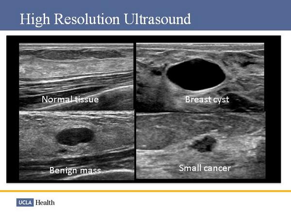 UCLA Health on Twitter: quot;What does breastcancer on an ultrasound look like ↓ UCLAMDChat http 