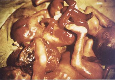 UnwantedAngels's tweet image. This is what you find in abortion clinics!!