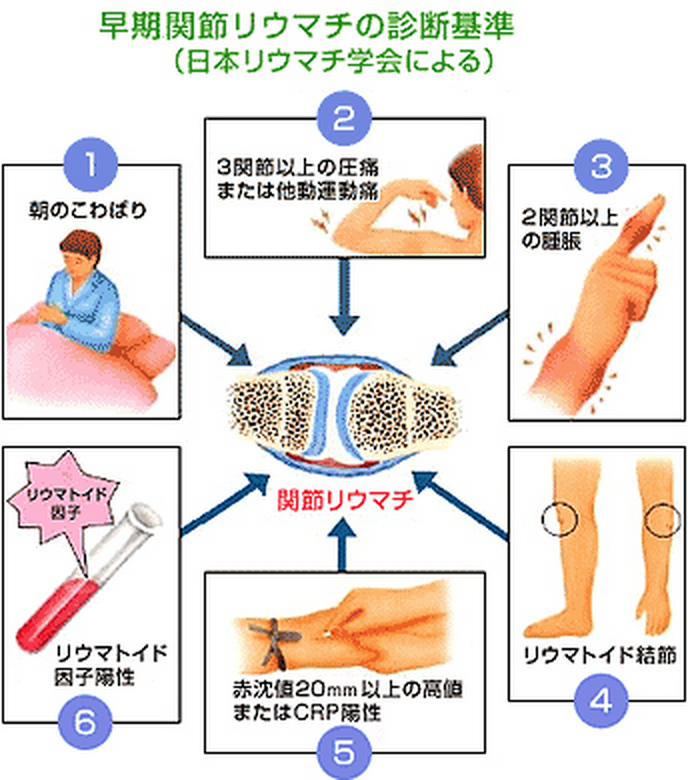 ゴロ 解剖生理イラスト 関節リウマチの初期症状 Http T Co Qizr3ewhbc Twitter