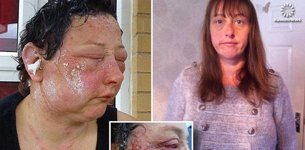 سيدة تصاب بالتسمم ومهددة بالعمى لاستخدامها صبغة شعر ktne.ws/1gK