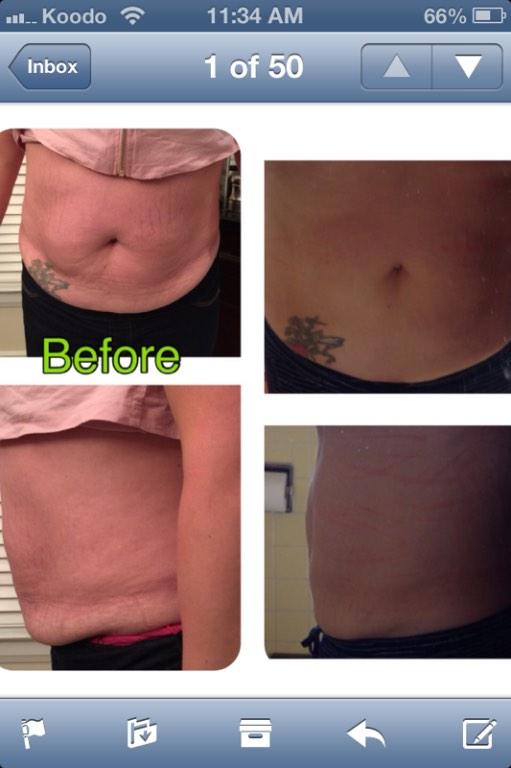 Check out my first clients results after 1 wrap and 72 hours. AMAZING.