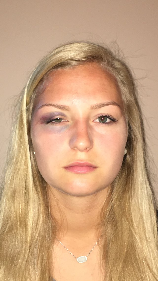 BillGolden1's tweet photo. Senior soccer night ✅ tying the #1 soccer team in the country ✅ nice black eye for daughter 2 days before prom ✅ https://t.co/c0hobRMIsy