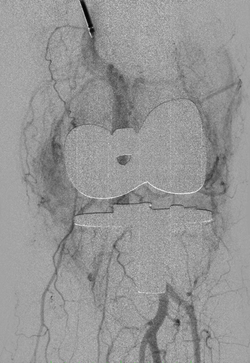 Sandeep Bagla MD (@sandeepbaglamd) on Twitter photo #knee #embolization #hemarthrosis. Dup Med Sup Genicalate with hyper vascular synovium. ncbi.nlm.nih.gov/pubmed/26092252 <a href="/VIRTarHeels/">UNCVIR</a> <a href="/OrthoToday/">Orthopedics Today</a> #knee #embolization #hemarthrosis. Dup Med Sup Genicalate with hyper vascular synovium. ncbi.nlm.nih.gov/pubmed/26092252 <a href="/VIRTarHeels/">UNCVIR</a> <a href="/OrthoToday/">Orthopedics Today</a>