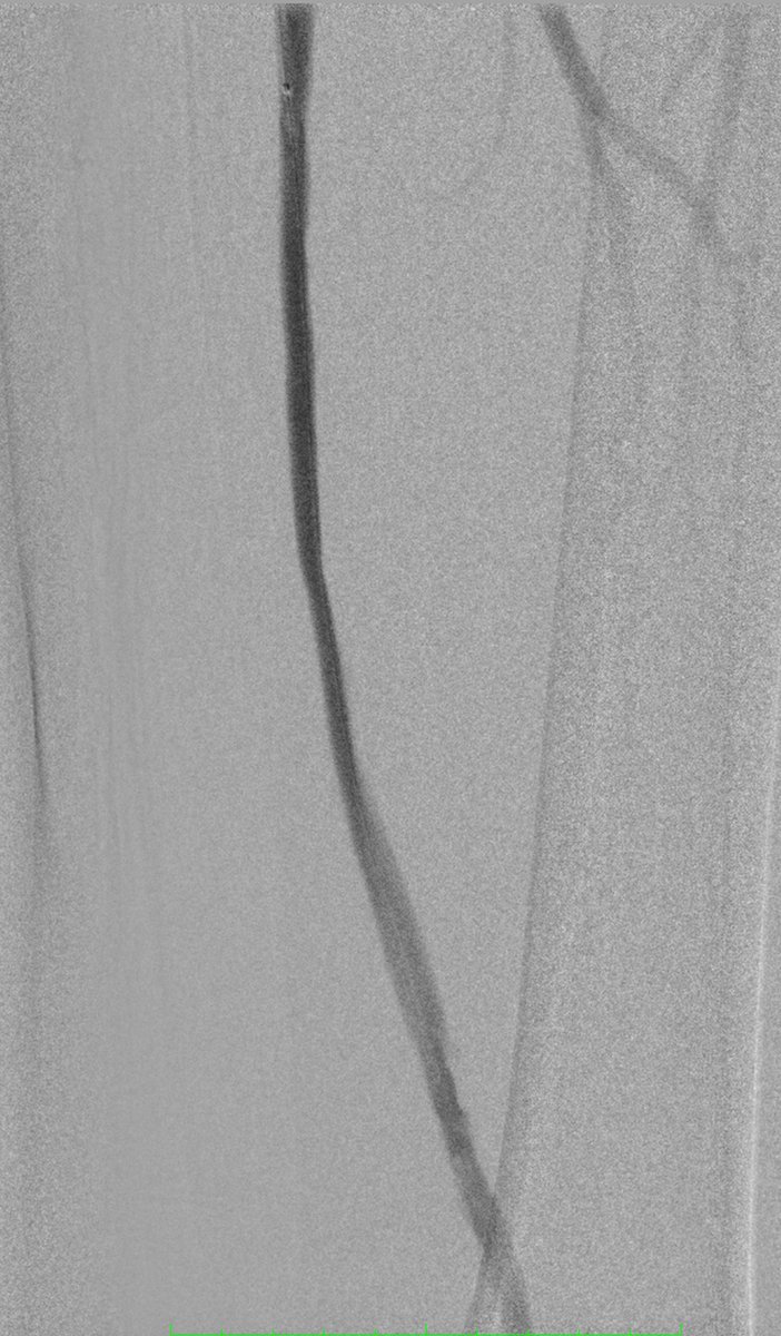 Sandeep Bagla MD (@sandeepbaglamd) on Twitter photo #floss today? Rubicon, Command, Plasty & Stent <a href="/bsc_pi/">Jeff Mirviss</a> <a href="/AbbottNews/">Abbott</a> <a href="/terumobct/">Terumo Blood and Cell Technologies</a> <a href="/ISETNews/">ISET</a> <a href="/Team_VIV/">Vascular Inst of VA</a> <a href="/MountSinaiIR/">Mount Sinai IR</a> <a href="/Drshiloh/">Aaron Shiloh MD FSIR</a> #floss today? Rubicon, Command, Plasty & Stent <a href="/bsc_pi/">Jeff Mirviss</a> <a href="/AbbottNews/">Abbott</a> <a href="/terumobct/">Terumo Blood and Cell Technologies</a> <a href="/ISETNews/">ISET</a> <a href="/Team_VIV/">Vascular Inst of VA</a> <a href="/MountSinaiIR/">Mount Sinai IR</a> <a href="/Drshiloh/">Aaron Shiloh MD FSIR</a>