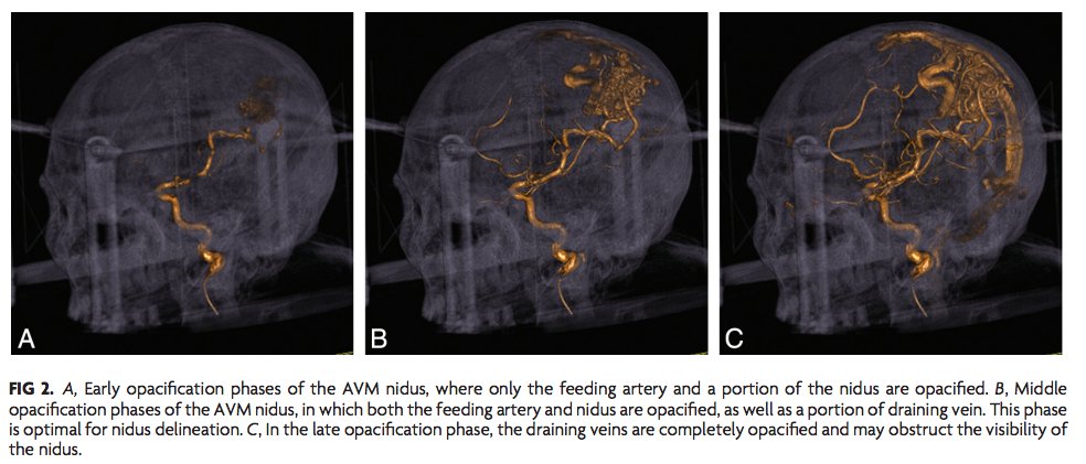 Application of Time-Resolved 3D DSA to Plan Cerebral #AVM Radiosurgery bit.ly/2qCdsvP #NeuroIR