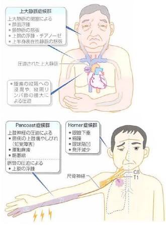 怒張