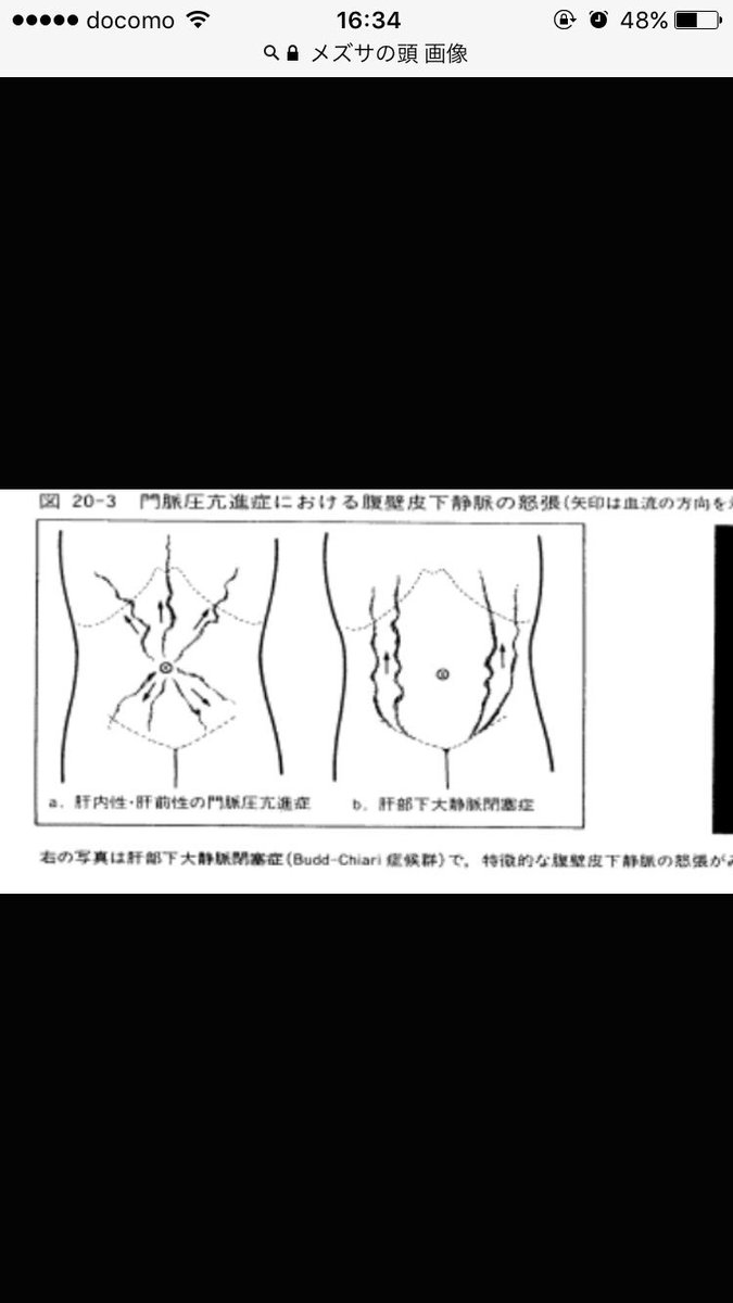 ぴぃ 静脈怒張 上大静脈症候群 前胸部や腕 下行性 Budd Chiari症候群 腹壁 上行性 門脈圧更新症の肝前あるいは肝内性 メズサの頭 肝硬変 細部中心 上下方向の血管怒張 ちなみに 上大静脈症候群は上肢の浮腫 疼痛があればpancoast肺癌 T Co