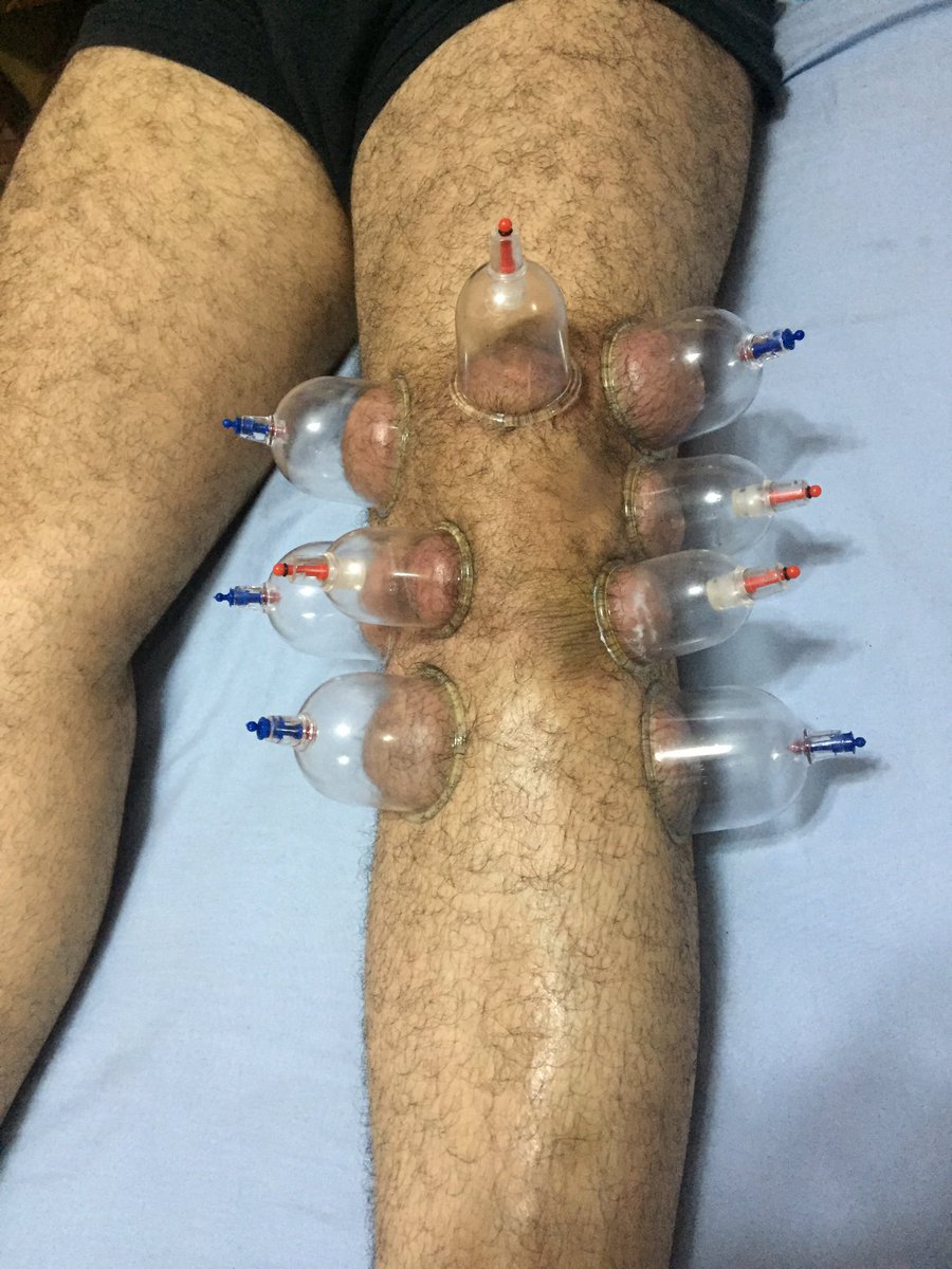 حجامه لعلاج مشاكل الركبه