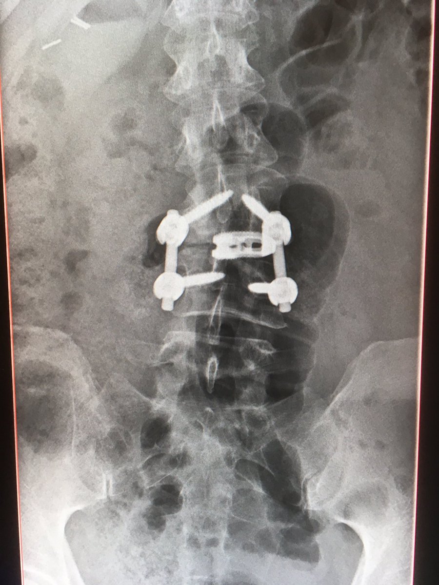 bionicpiggy's tweet image. This is why I've been quiet 4 so long.The pain has been horrendous.Op 4 my new back was last Friday...now it's onwards &amp;amp; upwards. Back soon!