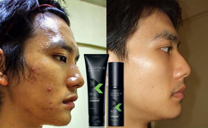 nutati's tweet image. ถ้าผิวไม่สะอาด สิวก็เกิดนะครับ 
ลองใช้นี่เลย โฟมล้างหน้า + ครีมโกนหนวด 
ลดสิว ลดผิวมัน ผิวใสตั้งแต่ครั้งแรก 
ใช้ได้ 3-4 เดือน คุ้มสุดสั่งเลย