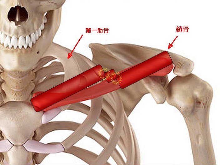 ヘタレなおじさん 衝撃の事実判明 私の鎖骨 15年以上折れたままだったようです O 私の鎖骨は3つの骨が 軽く繋がった 状態 だったもよう 知らなかったぁ なお痛みは 第一肋骨骨折 が原因との事 どちらにしてもしっかり治して夏には