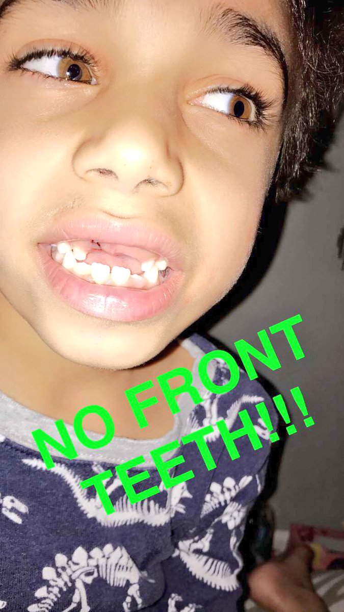 AYO_BO's tweet image. ANOTHA ONE 😁#TwoFrontTeeth #ToothFairy