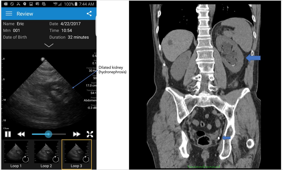 Eric Topol I Ve Been Battling A Kidney Stone All Wk Losing So I Did A Smartphone Ultrasound Of My Kidney Dx Dilated Then To Er Ct Scan Confirmed T Co Vynjeeoqgw