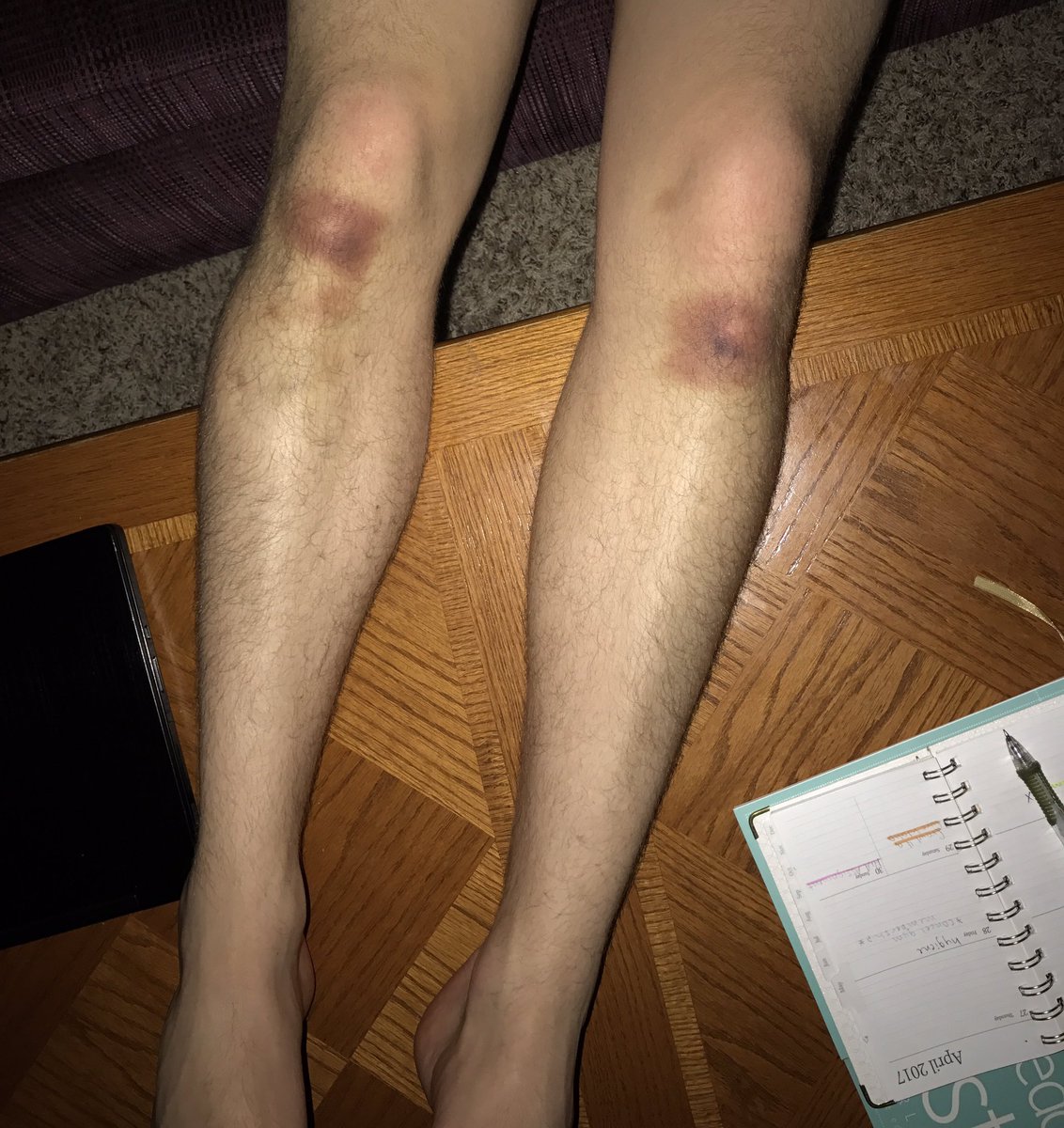 ashedwardson's tweet photo. What does a person have to do to receive these bruises? 🤔🤔🤔#TannerGoesToVegas https://t.co/TedV5W1OsY