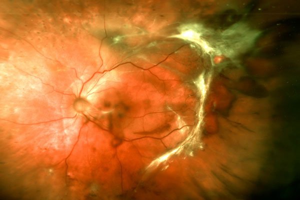 Harvard Medical School (@harvardmed) on Twitter photo HMS researchers at <a href="/MassEyeAndEar/">Mass Eye and Ear</a> have identified a new target for abnormal blood vessel growth in the eye hvrd.me/mhYC30aZwMZ HMS researchers at <a href="/MassEyeAndEar/">Mass Eye and Ear</a> have identified a new target for abnormal blood vessel growth in the eye hvrd.me/mhYC30aZwMZ