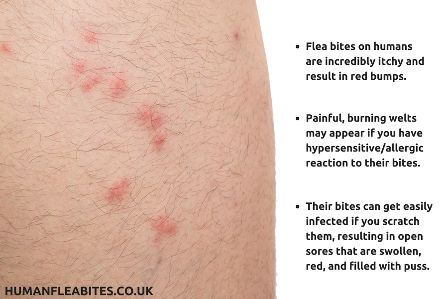 Flea bites treatment human hot sale