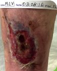 Ulcerasnet's tweet photo. Caso clínico mujer de 91 años herida traumática m.inferior tratada con #UrgoCleanAg @UrgoMedical_es https://t.co/pmqEyIH7WO