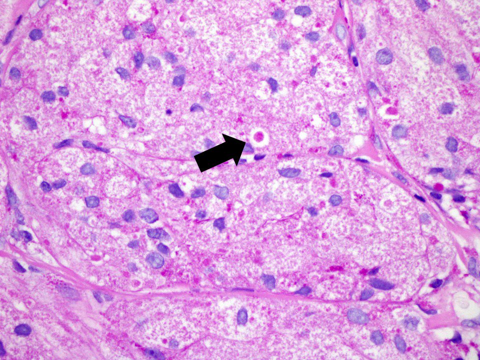 Pustulo-ovoid bodies of Milian granular cell tumor #pathology #SurgPath #bstpath <a href="/poppins10doc/">Marypoppins</a>  <a href="/DraEosina/">Laura G. Pastrián MD</a> <a href="/bodies4u/">Dr Phil Bryant</a> ncbi.nlm.nih.gov/pubmed/17448196