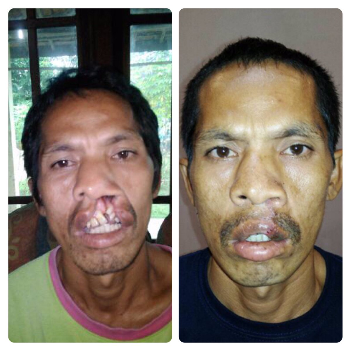 SmileTrain Indonesia tweet media