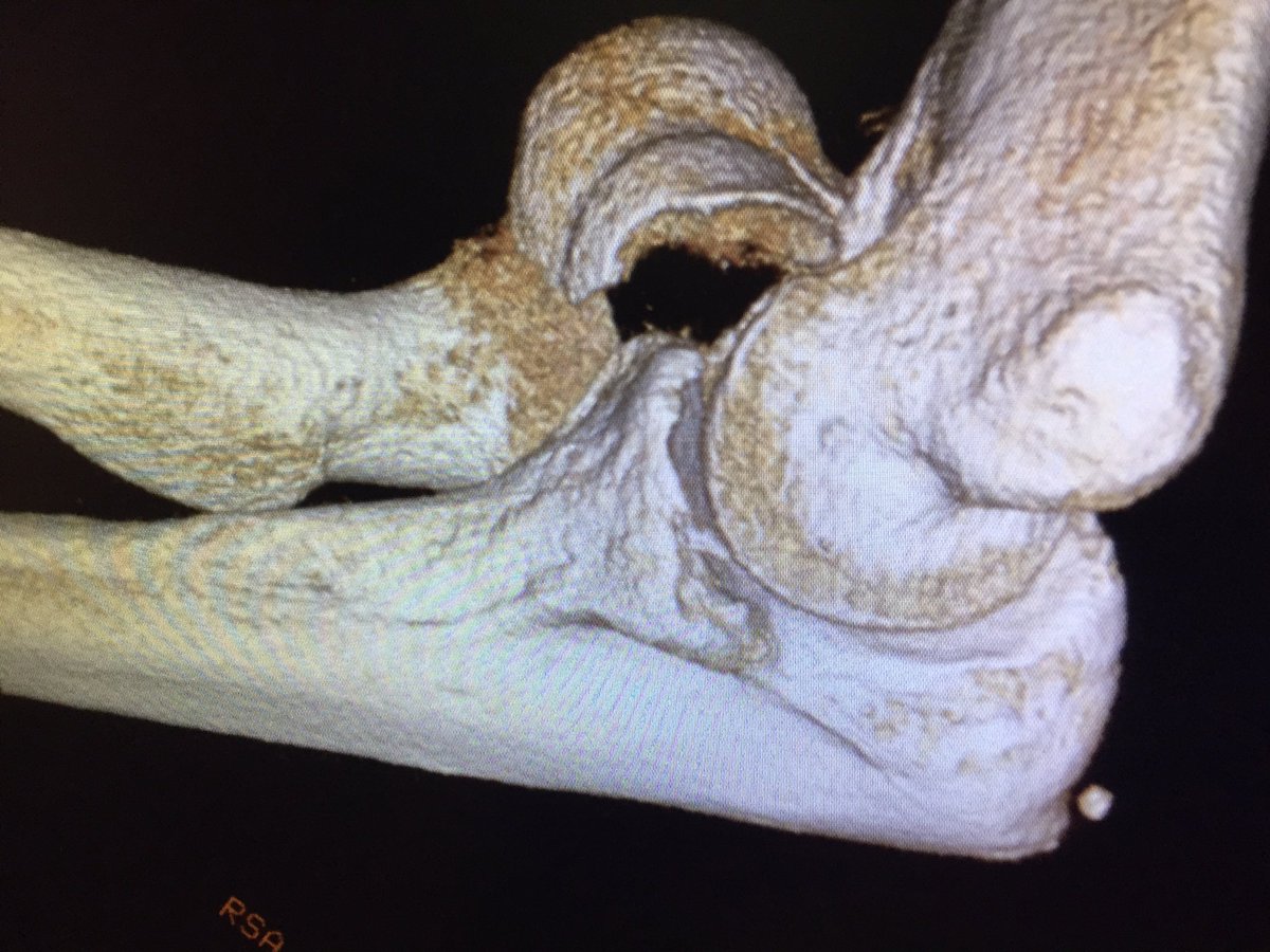 Fractura articular parcial de extremo distal de humero, incarcerada y a expensas de columna lateral. #cbct #newtom #ct #trauma #fractura